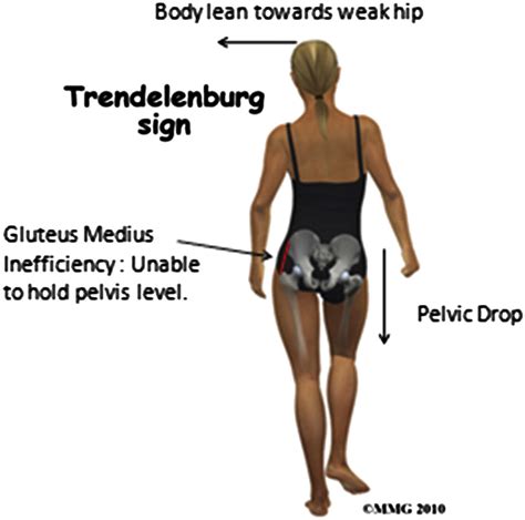 what is positive trendelenburg sign